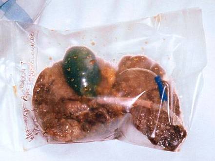 My hard working liver that was removed.